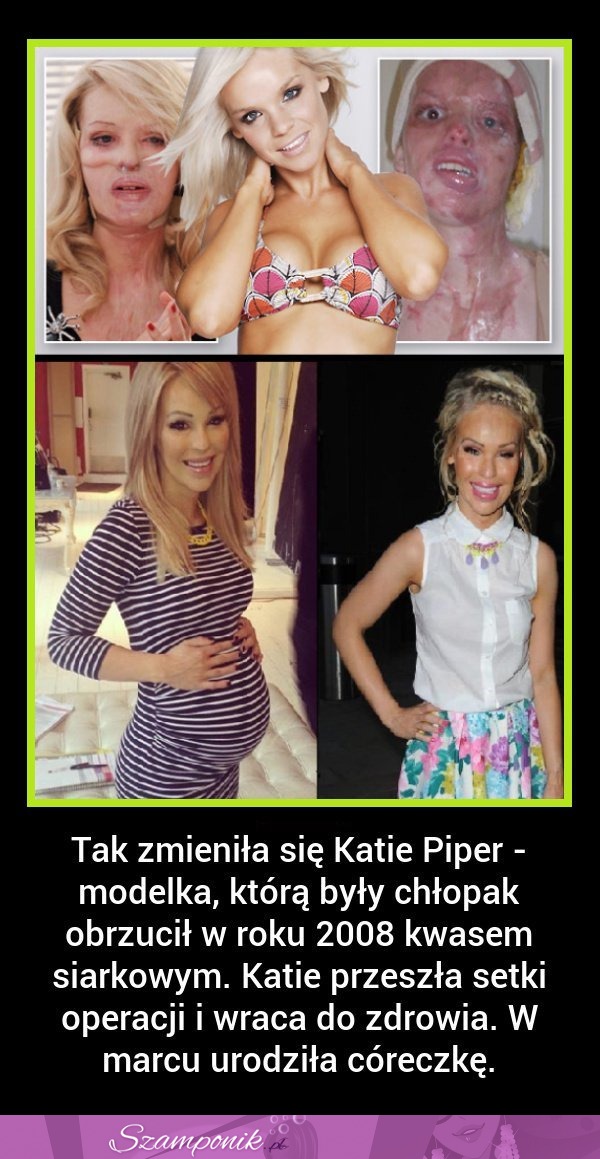 Tak zmieniła się Katie Piper - modelką, którą były chłopak oblał kwasem! SZOK